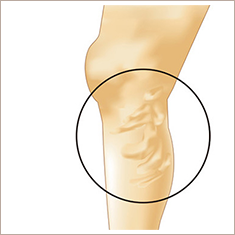 下肢静脈瘤とは
