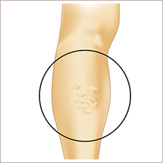 下肢静脈瘤とは
