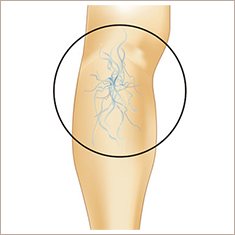 下肢静脈瘤とは