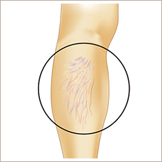下肢静脈瘤とは